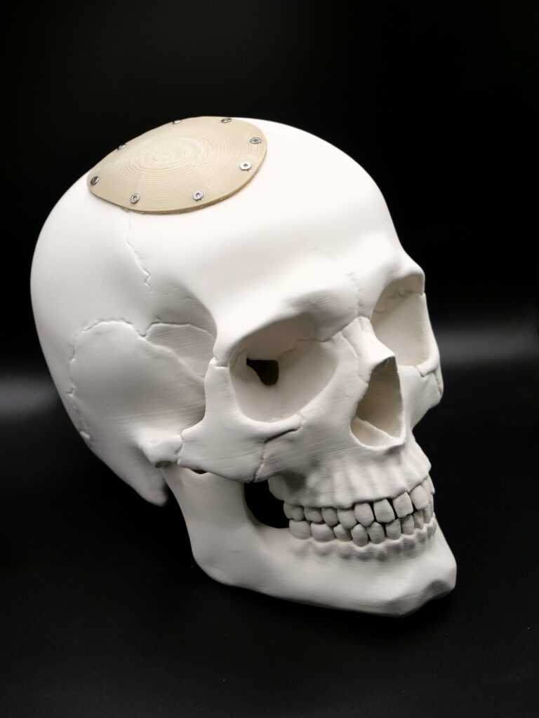 Kit chirurgical crânien impression 3D médical — TiPi3D